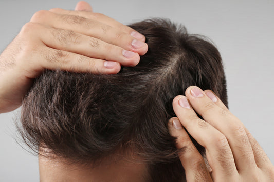 Minoxidil Shedding: Why Hair Loss Can Look Worse Before It Gets Better