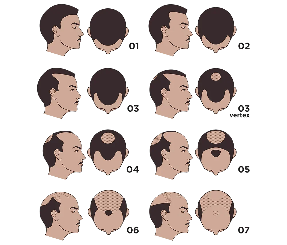 The Norwood Scale Explained: What Stage Is Your Hair Loss? (And What to Do at Each Stage)