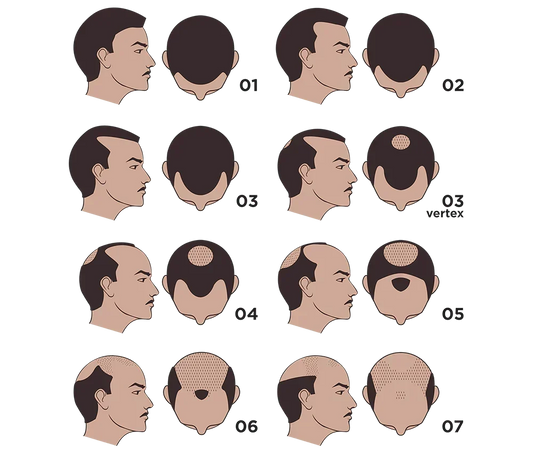 The Norwood Scale Explained: What Stage Is Your Hair Loss? (And What to Do at Each Stage)
