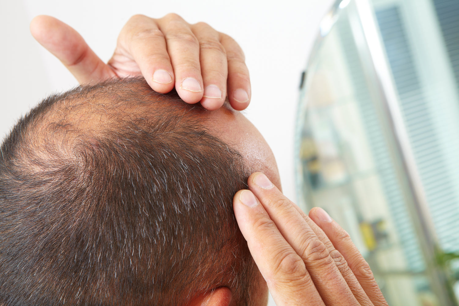 Mechanism and causes of male pattern baldness, man touching hair loss area.