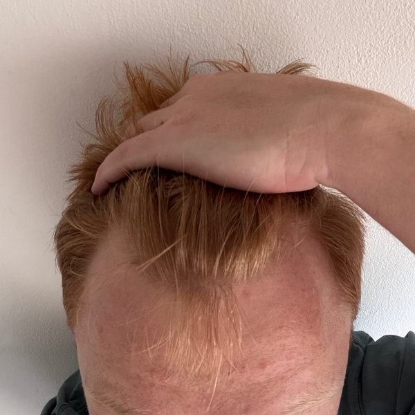 After treatment