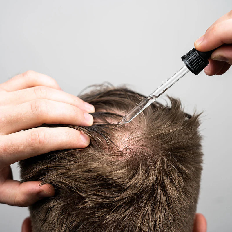 Man applying topical hair treatment commonly containing minoxidil and finasteride.
