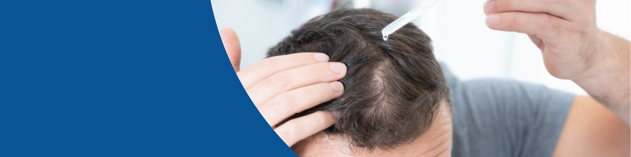 Man with brown hair applying topical hair loss treatment solution for scalp.