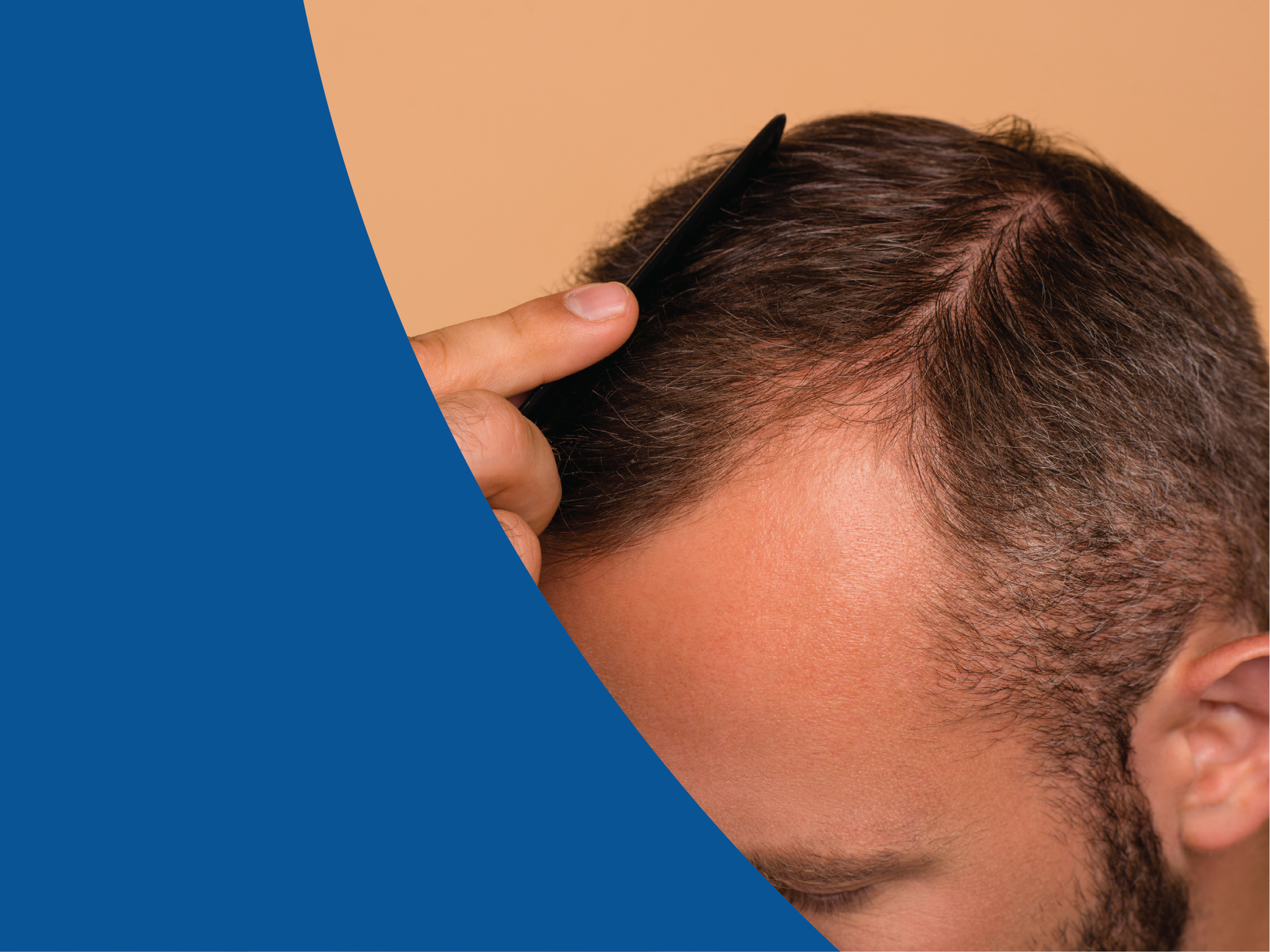 Man with comb in hair as example of early stage of hair thinning in men.