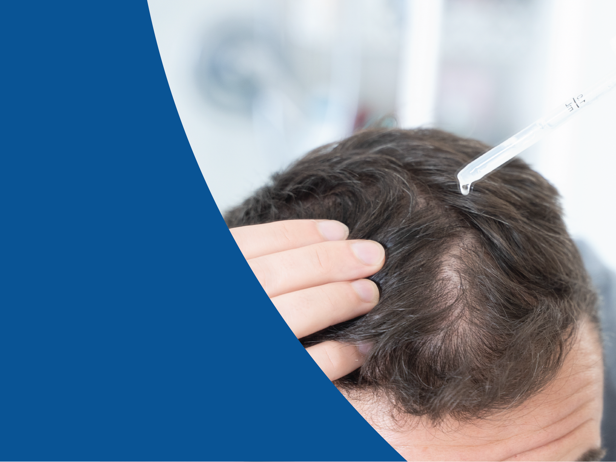 Man with brown hair applying topical hair loss treatment solution for scalp.