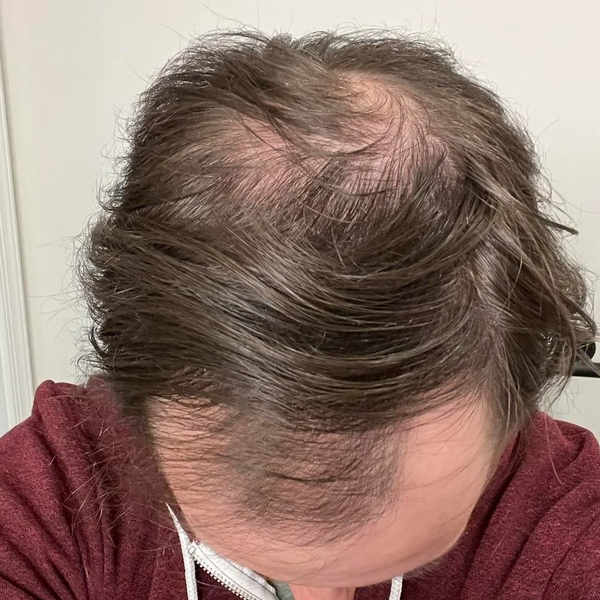 Before treatment