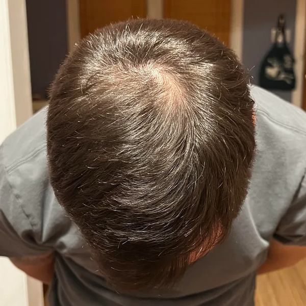 After treatment