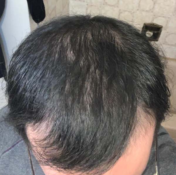 After treatment
