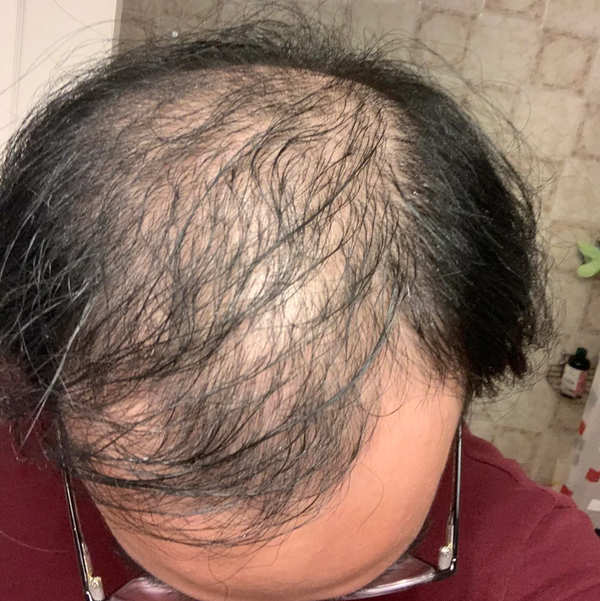 Before treatment