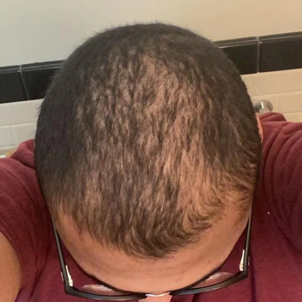Before treatment