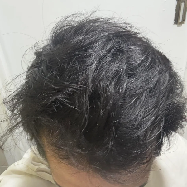 After treatment