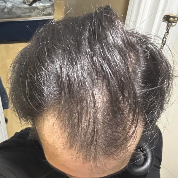 Before treatment
