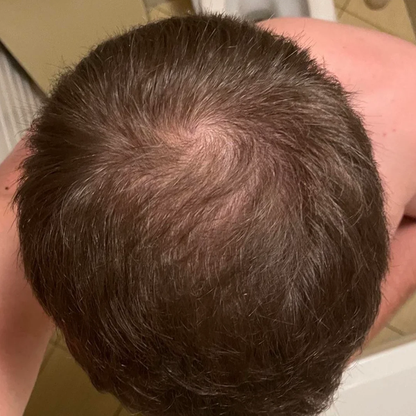 After treatment