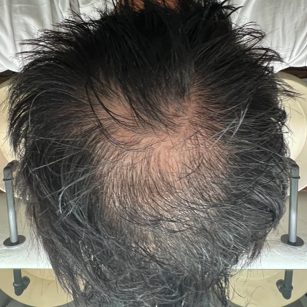 Close-up of a person's head with thinning hair and visible scalp before topical hair loss treatment.