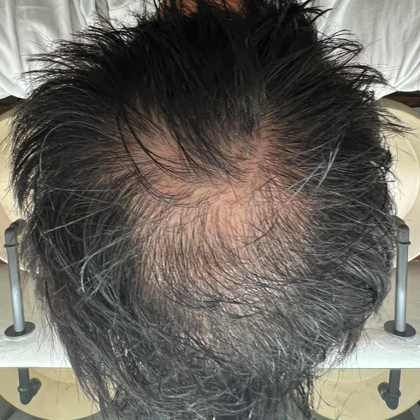 Before treatment