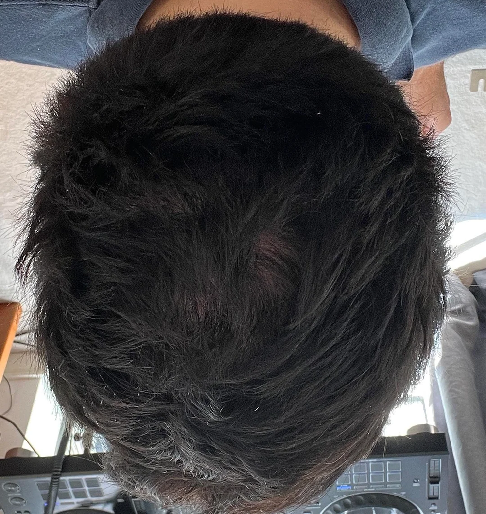 Close-up of a person dark hair after topical hair loss treatment.