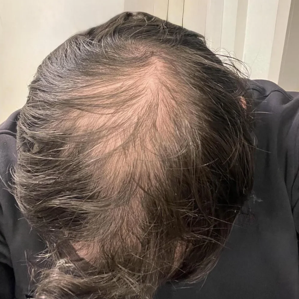 Before treatment