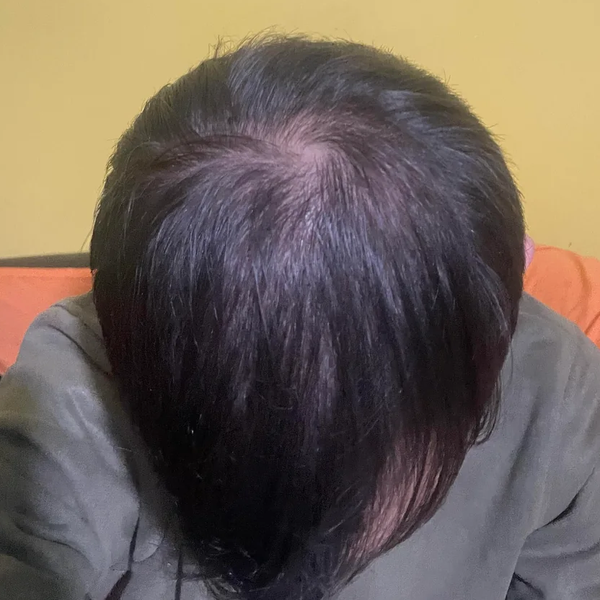 After treatment