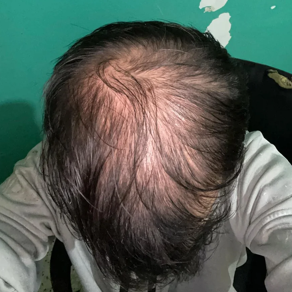 Before treatment